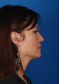 Rhinoplasty