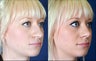 Revision Rhinoplasty
