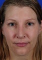 Revision Rhinoplasty
