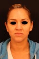 Revision Rhinoplasty with septal perforation repair