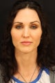 Revision Rhinoplasty with open Nasoseptal reconstruction