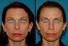Revision Rhinoplasty (open)