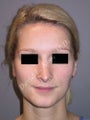 Rhinoplasty