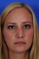 Revision Rhinoplasty