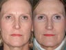 Revision rhinoplasty