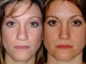 Revision rhinoplasty