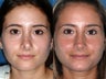 Revision rhinoplasty