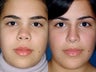 Revision rhinoplasty