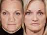 Revision rhinoplasty