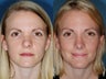 Revision rhinoplasty