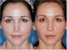 Revision rhinoplasty