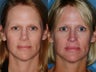 Revision rhinoplasty