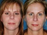 Revision rhinoplasty