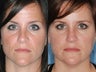 Revision rhinoplasty