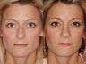 Revision rhinoplasty