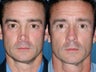 Revision rhinoplasty