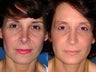 Revision rhinoplasty