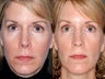 Revision rhinoplasty