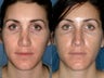 Revision rhinoplasty