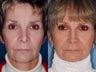 Revision rhinoplasty
