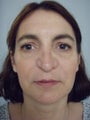 Revision Rhinoplasty
