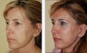 Revision Rhinoplasty