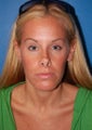Revision Rhinoplasty