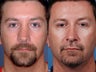 Revision rhinoplasty