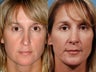 Revision rhinoplasty