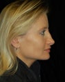 Revision Rhinoplasty