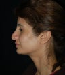 Revision Rhinoplasty