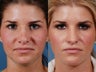 Revision rhinoplasty