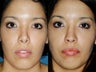 Revision rhinoplasty