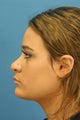 Revision Rhinoplasty