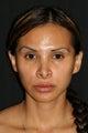 Rhinoplasty revision 