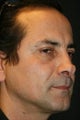 Male Rhinoplasty Revision