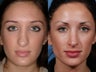 Revision rhinoplasty
