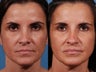 Revision rhinoplasty