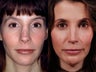 Revision rhinoplasty