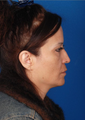 Rhinoplasty