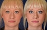 Revision Rhinoplasty