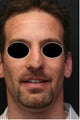 Revision Rhinoplasty of a Cleft Lip Nose