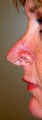 Revision Rhinoplasty