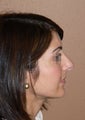 Rhinoplasty/nose job surgery