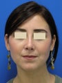 Rhinoplasty