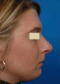 Rhinoplasty