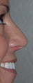 Rhinoplasty - Hump Reduction, Lift Drooping Tip