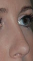 Rhinoplasty - Refine tip, Widen Dorsum