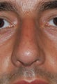 Rhinoplasty, Deviated Septum