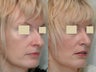 Rhinoplasty
